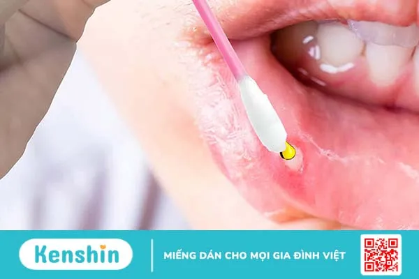 Cách chọn thuốc mỡ bôi nhiệt miệng hiệu quả nhanh chóng 2