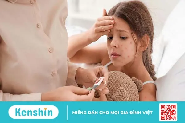 Cách chữa bệnh thủy đậu ở trẻ em, bố mẹ cần biết! 4