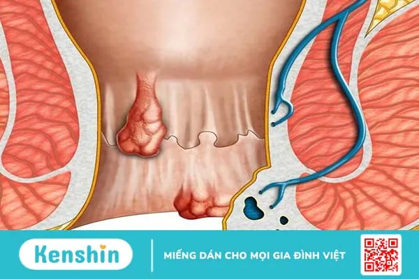 Bệnh trĩ thuộc bệnh lý hậu môn trực tràng