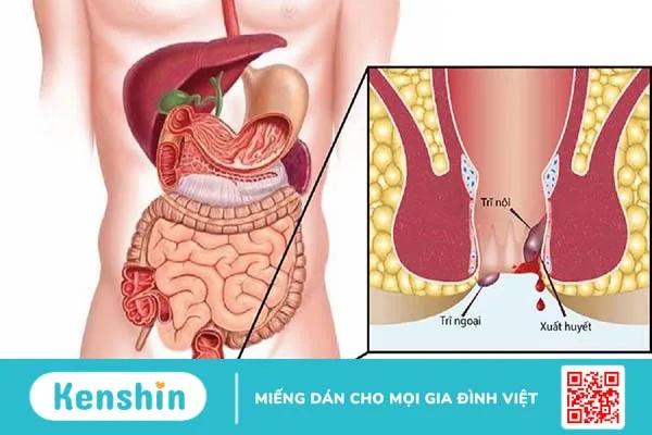 Bệnh trĩ có 2 dạng thường gặp là trĩ nội và trĩ ngoại