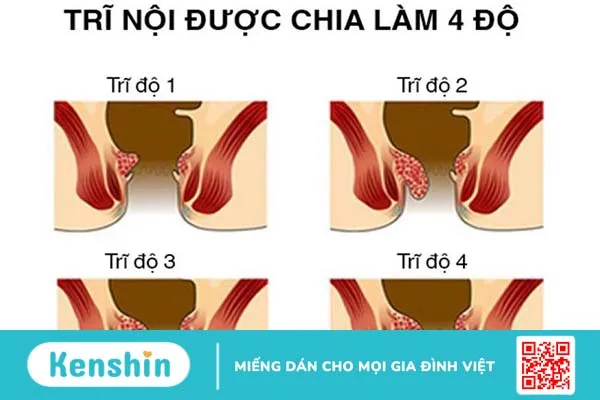 Bệnh trĩ cấp độ 4 có thể gây sưng tấy hậu môn