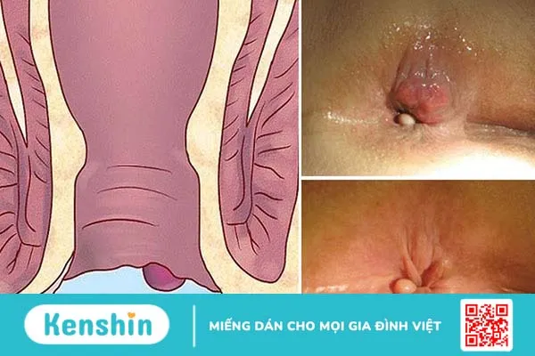 Cách chữa bệnh trĩ ngoại tại nhà hiệu quả nhất 1