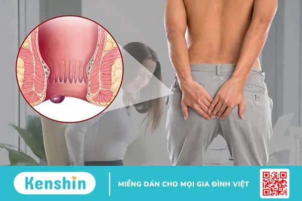 Cách chữa bệnh trĩ ngoại tại nhà hiệu quả nhất 3