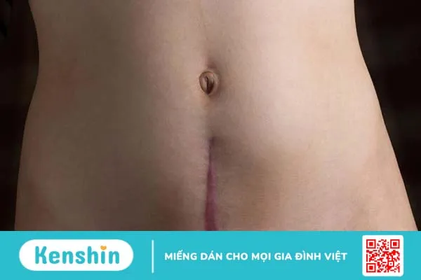 Cách chữa sẹo lồi sinh mổ 1