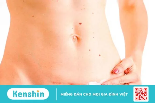 Cách chữa sẹo lồi sinh mổ 2