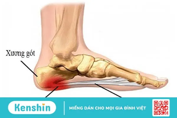 Cách chữa viêm cân gan bàn chân dứt điểm bằng phương pháp huyết tương giàu tiểu cầu (PRP) 1