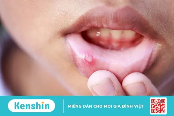 Cách chữa viêm loét miệng hiệu quả 1