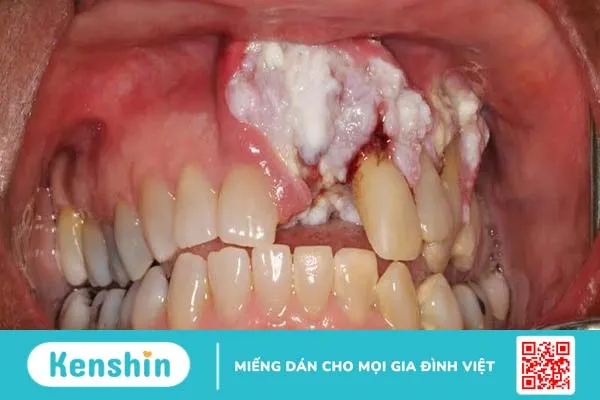 Cách điều trị ung thư nướu răng 1