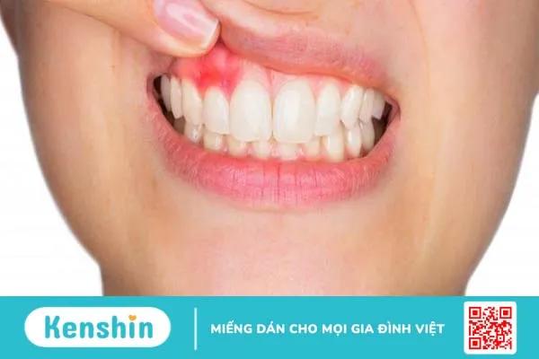 Cách điều trị ung thư nướu răng 2