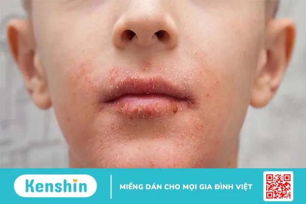 Biểu hiện khi bị dị ứng kem đánh răng