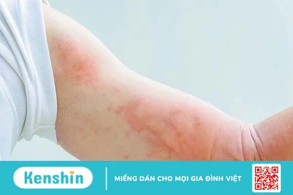 Một số người có thể bị sốc phản vệ khi bi dị ứng kem đánh răng