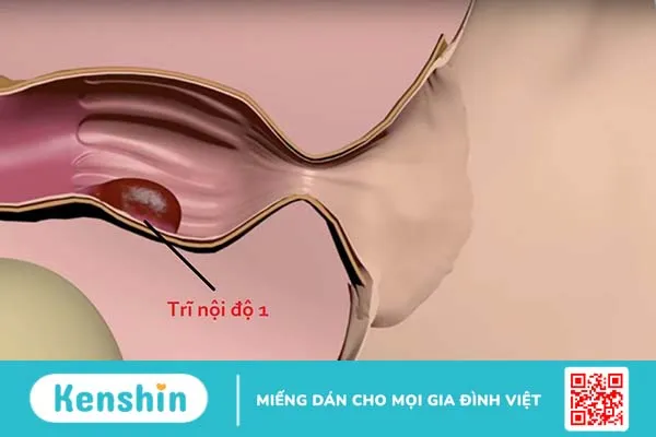 Cách dùng cây cỏ xước chữa bệnh trĩ an toàn và hiệu quả 1