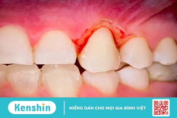 Cách khắc phục răng mọc chồi như thế nào cho hiệu quả? -3