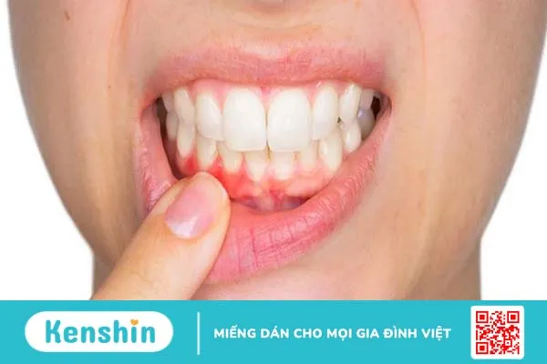 Súc miệng với dầu dừa giúp chống viêm nướu