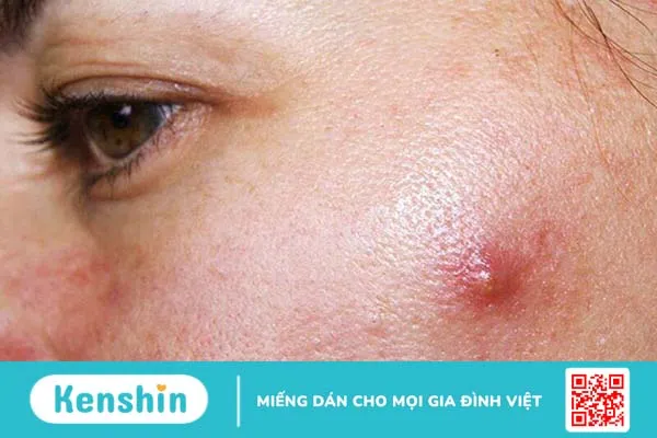 Cách làm xẹp mụn sưng đỏ sau 1 đêm bạn đã biết chưa? 1