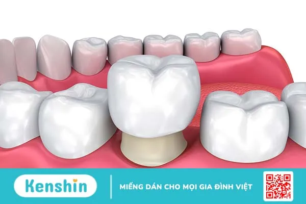 Bọc sứ khắc phục tình trạng men răng bị hỏng