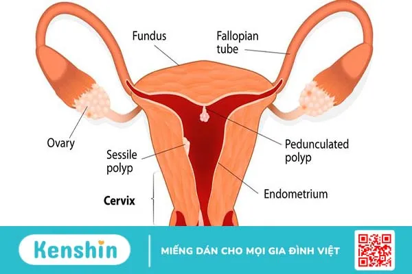 Polyp tử cung là gì? Cách phân biệt polyp tử cung và u xơ tử cung 1