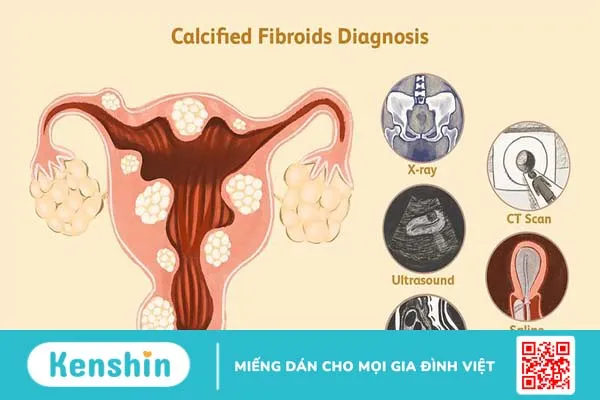 Polyp tử cung là gì? Cách phân biệt polyp tử cung và u xơ tử cung 4