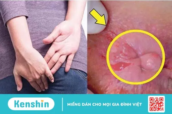 Cách phòng bệnh trĩ hiệu quả mà bạn nên biết 2