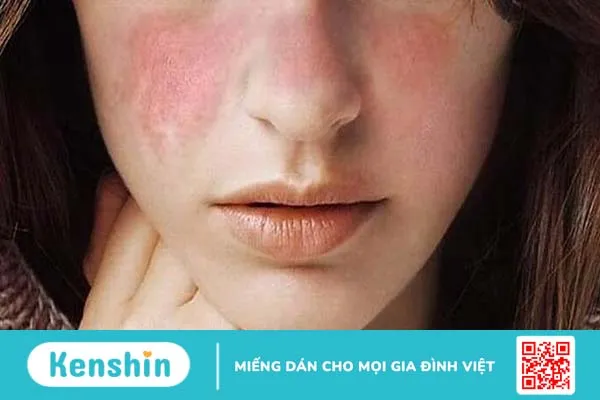 Cách phục hồi da sau dị ứng mỹ phẩm hiệu quả bất ngờ 1