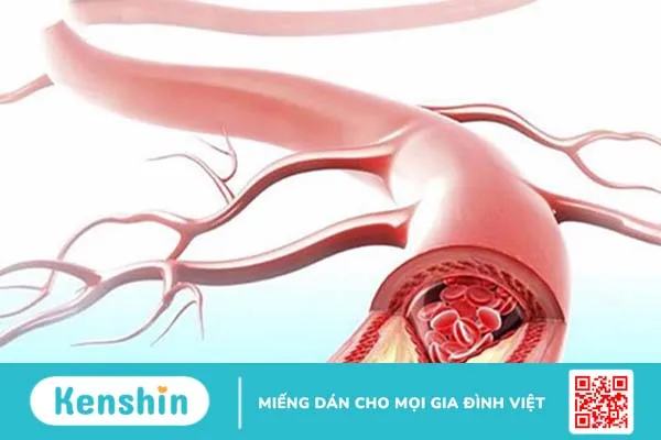 Sơ cứu vết thương chảy máu mao mạch và tĩnh mạch đúng cách và an toàn 1