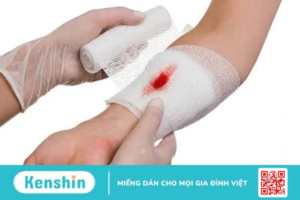 Sơ cứu vết thương chảy máu mao mạch và tĩnh mạch đúng cách và an toàn 5