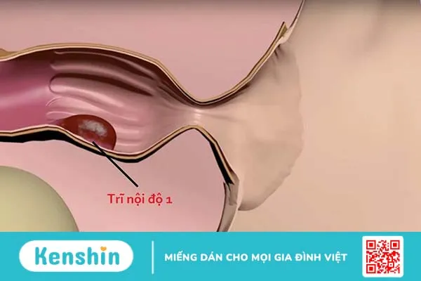 Cách sử dụng rượu tỏi chữa bệnh trĩ hiệu quả tại nhà 1