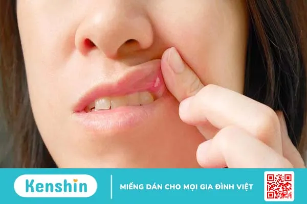 12+ cách trị nhiệt miệng trong 1 ngày đơn giản ai cũng thực hiện được 1