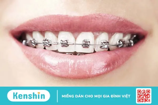 Cách vệ sinh răng miệng sau khi niềng răng rất quan trong giúp bảo vệ sức khoẻ răng miệng