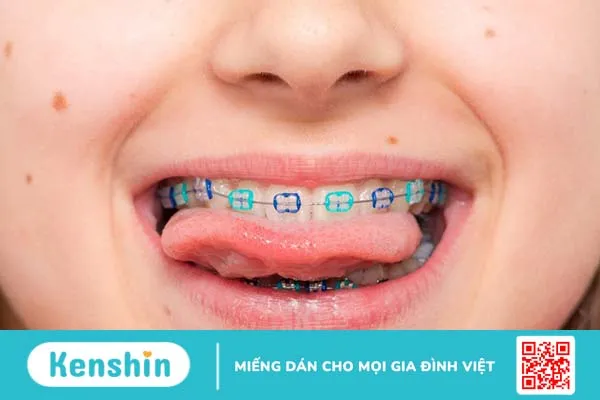 Cách vệ sinh răng miệng sau khi niềng răng giúp hạn chế tình trạng viêm nha khoa