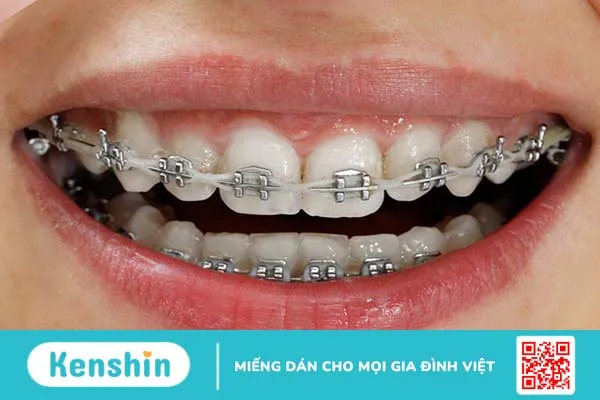 Vệ sinh răng miệng sau khi niềng răng như thế nào? 3