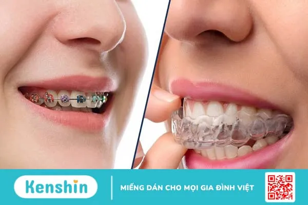 Cách vệ sinh răng miệng sau khi niềng răng