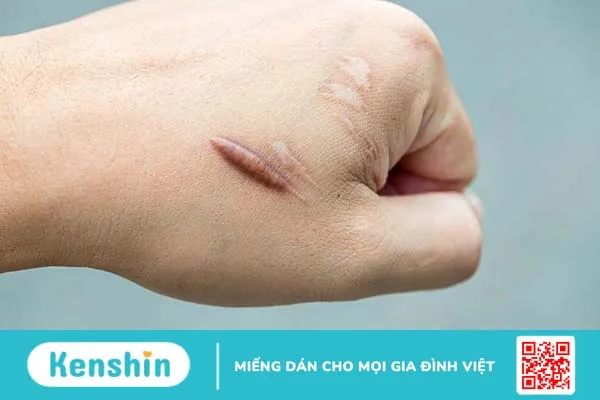 Cần kiêng ăn bao lâu để tránh sẹo lồi bạn đã biết rõ chưa?1