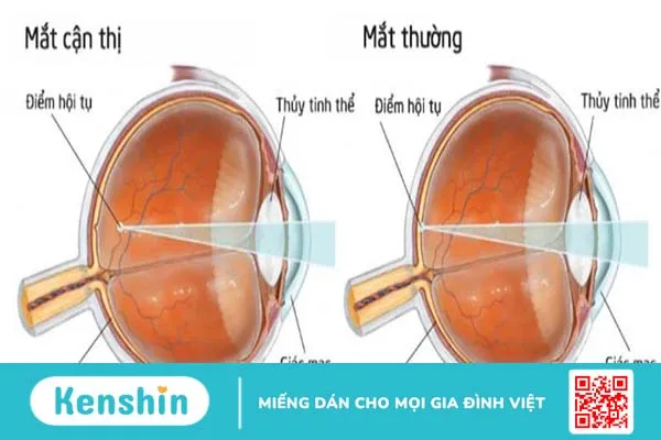 Cận thị sau 30 tuổi có nguy hiểm không? 2