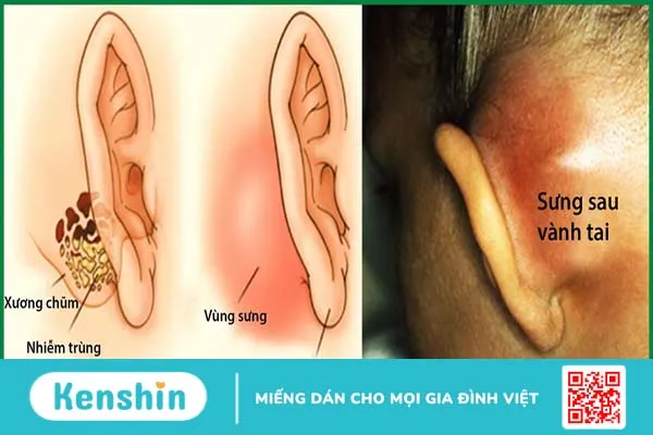 Cảnh giác những biến chứng khôn lường của viêm tai xương chũm có cholesteatoma 1