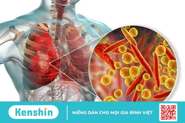 Cảnh giác với viêm phổi do vi khuẩn Mycoplasma gia tăng ở trẻ em 1