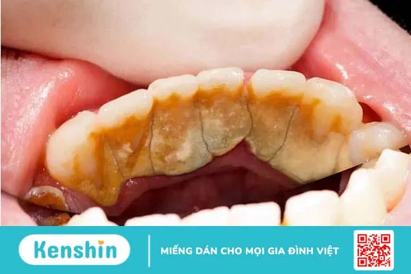 Cao răng là gì? Phân độ cao răng và cách loại bỏ, phòng ngừa cao răng 1