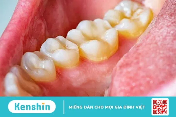 Cao răng là gì? Phân độ cao răng và cách loại bỏ, phòng ngừa cao răng 2