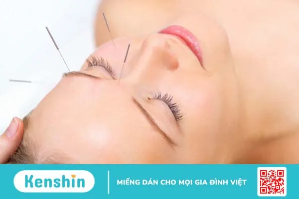 Châm cứu liệt dây thần kinh số 7 ngoại biên