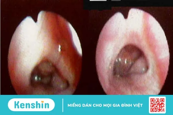 Viêm VA là gì và cách chăm sóc trẻ bị viêm VA 1