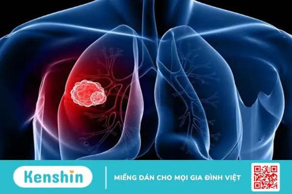 Giai đoạn ung thư được chia theo diễn tiến của tế bào ung thư