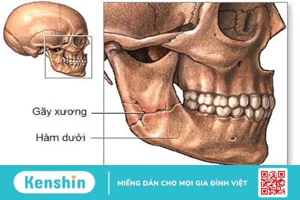 Chấn thương hàm mặt: Phân loại chấn thương và cách xử trí 2