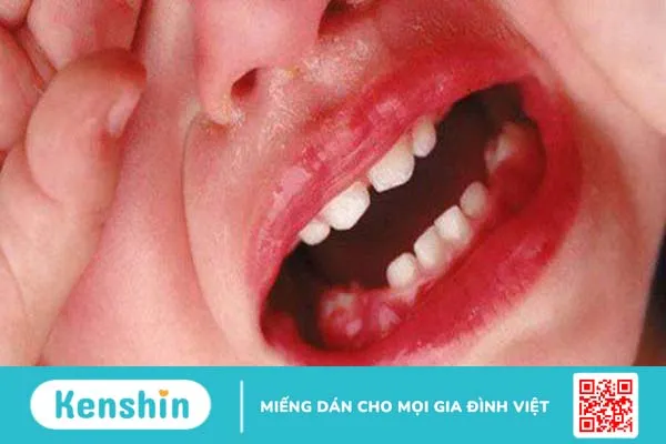 Chảy máu chân răng trẻ em: Nguyên nhân và cách điều trị 1