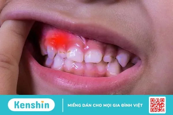 Chảy máu chân răng trẻ em: Nguyên nhân và cách điều trị 2