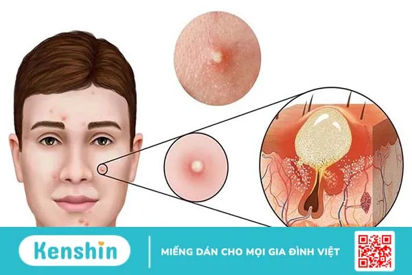 Chảy máu sưng viêm sau khi nặn mụn phải làm sao? 1