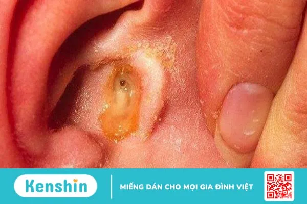 Chảy mủ tai ở trẻ em và những điều ba mẹ cần biết 1