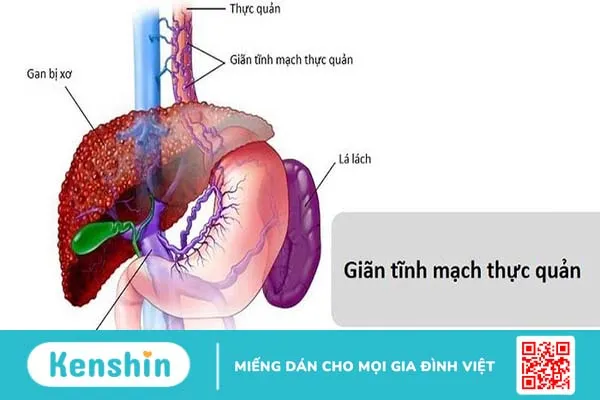 Chế độ ăn cho người giãn tĩnh mạch thực quản: Nên ăn gì, kiêng gì? 1