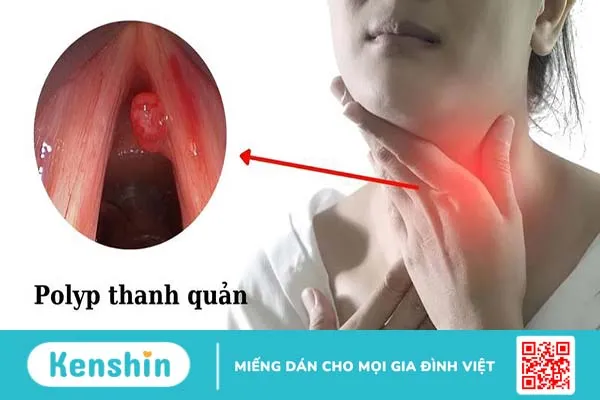 Chi phí cắt polyp thanh quản bao nhiêu? 1