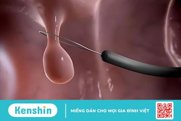 Chi phí cắt polyp thanh quản bao nhiêu? 2