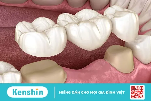 Chi phí làm cầu răng sứ là bao nhiêu? Có đắt không 1